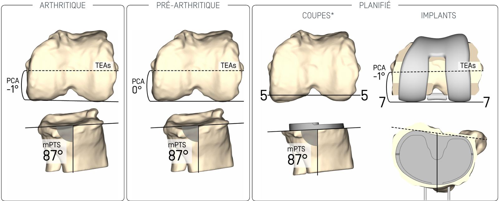 Planification de la rotation du fémur et de la pente du tibia