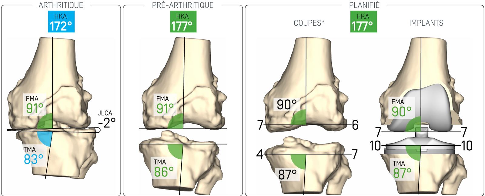 Planification de l'alignement du genou : genou arthrosique, pré-arthrosique et planifié avec implants