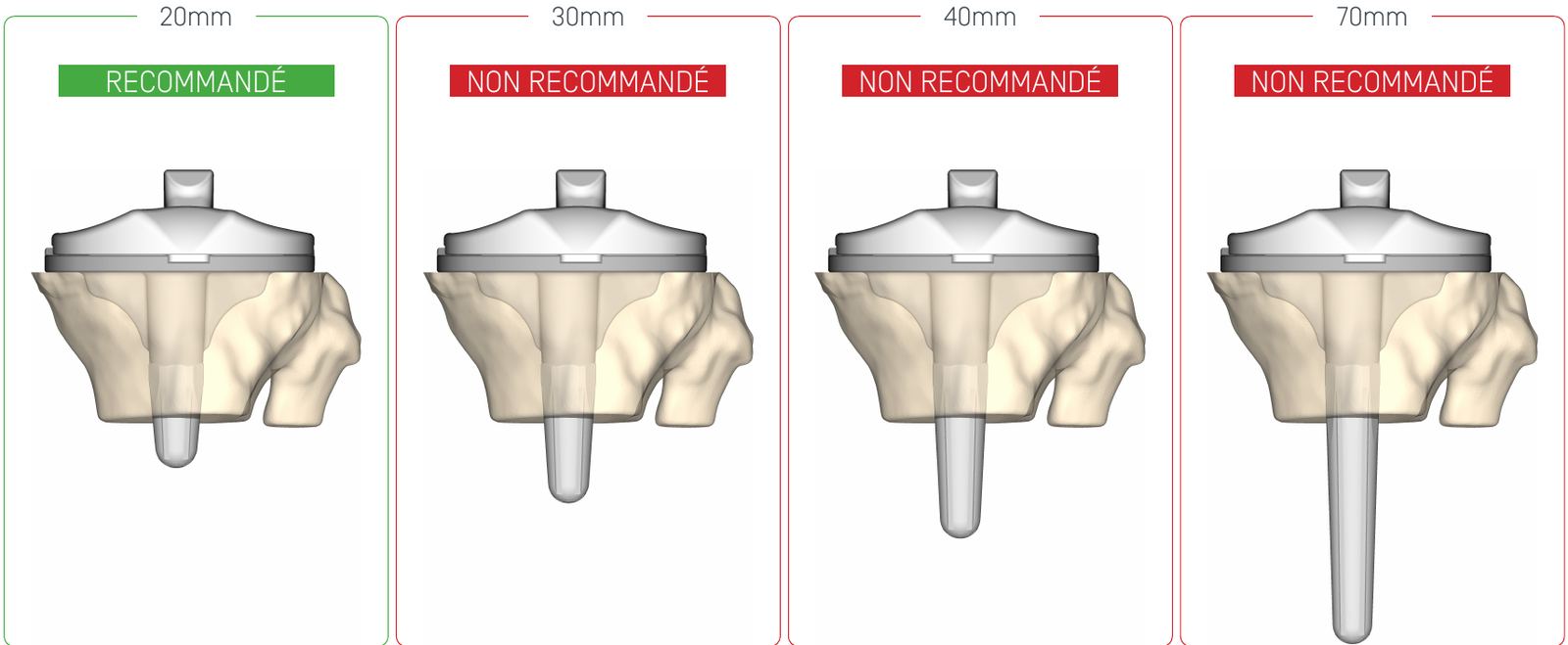 Comparaison de quatre longueurs de tige tibiale, la tige de 20 mm étant recommandée