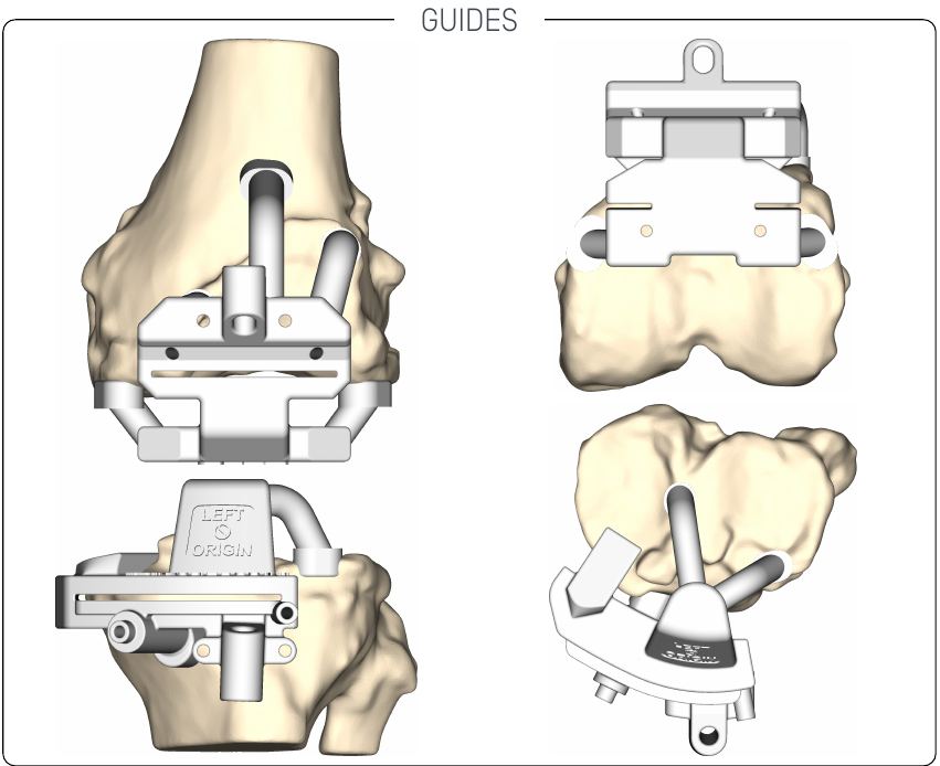 Guides de coupe personnalisés positionnés sur le fémur et le tibia